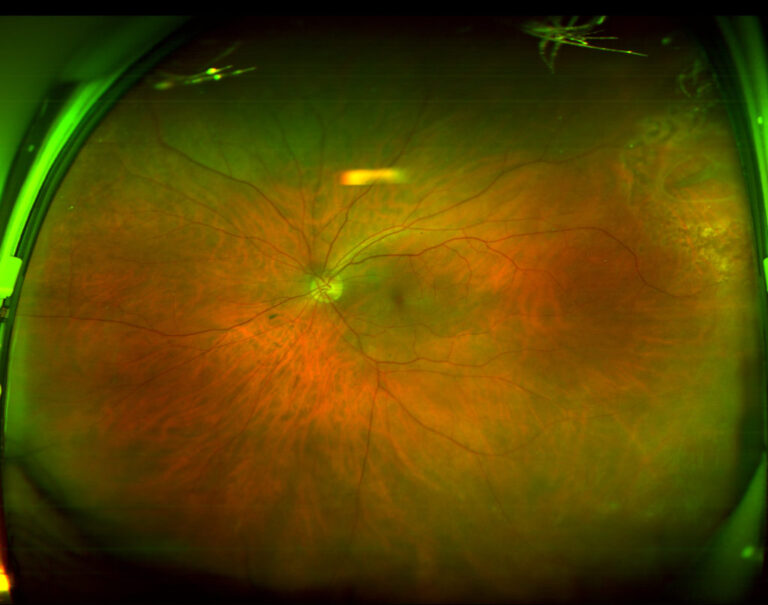 Retinal Screening Testing - Visual Eyes Group