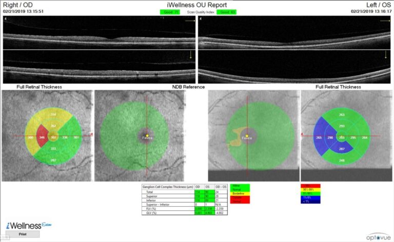 accuracy of retina scan